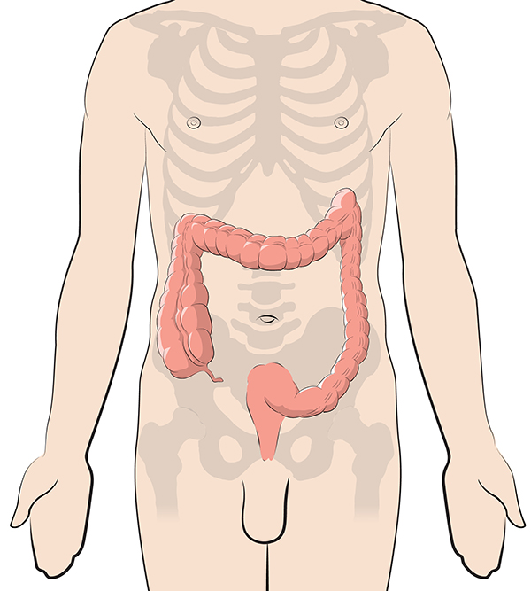 Hemorrhoids and Other Benign Conditions